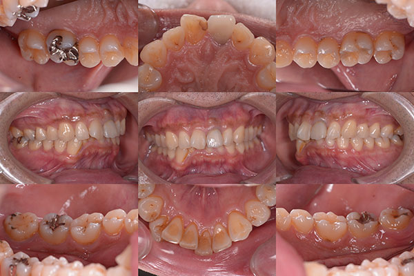 歯周治療症例