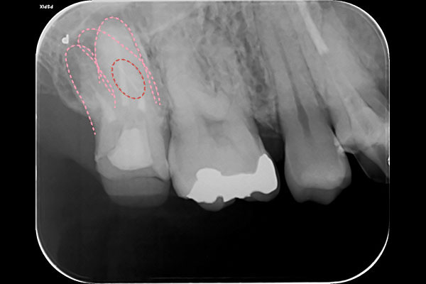 歯内療法症例