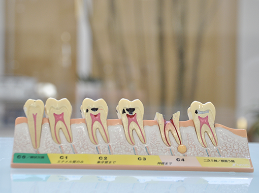 虫歯説明模型